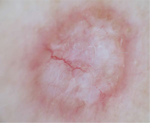 Dermoscopic image. Homogeneous whitish background with peripheral arborizing vessels and a red-brown halo.