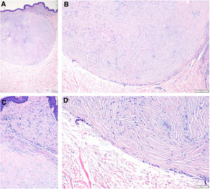 Histopathologic images. A, Circumscribed, nonencapsulated, nodular lesion in the dermis (hematoxylin-eosin, original magnification ×20). B, Paucicellular hyalinized collagen bundles separated by clefts and forming a storiform pattern (hematoxylin-eosin, original magnification ×40). C and D, Higher-magnification view showing a collarette of small collapsed vascular structures with evidence of microthrombi and erythrocyte extravasation (hematoxylin-eosin, original magnification ×200).