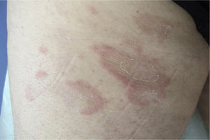 Clinical image. Annular plaques on the left thigh with erythematous borders and collarette scaling at the inner margin.