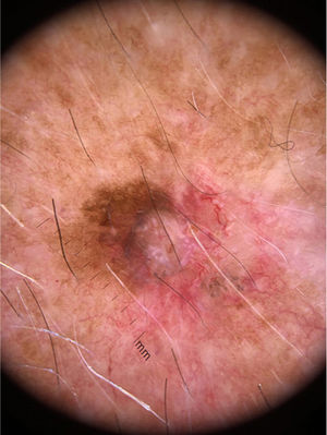 Dermoscopy of the lesion.