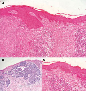 Histopathological study. A, Image showing tumor collision. B, Basal cell carcinoma. C, Lentigo maligna melanoma.