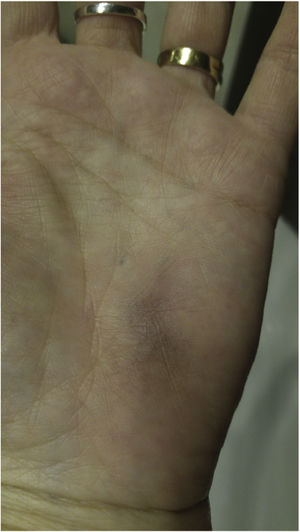 Ecchymotic purpura in the palm of the hand.