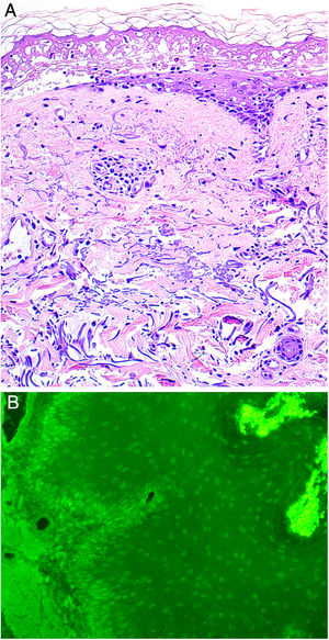 A. Histología reveladora de necrosis epidérmica, estrato córneo normal e infiltrado linfocítico perivascular y perianexal leve (H-E, x200). B. Inmunofluorescencia indirecta. La inmunofluorescencia de la sangre del paciente, realizada en esófago de mono demuestra la presencia de autoanticuerpos IgG en circulación ligados a los núcleos de queratinocitos epiteliales (dilución 1:20, amplificación original x200).