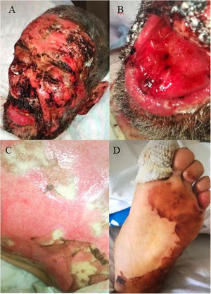 Grave afectación mucocutánea con piel denudada y formación de erosiones y costras. A) Zona facial; B) mucosa oral; C) espalda; D) planta.