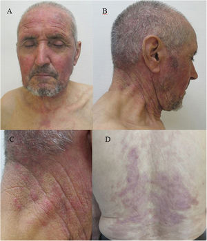 A y B) Eritema violáceo en áreas fotoexpuestas de zona facial y cuello. C) Detalle de cara lateral de cuello con zonas papulosas algo más infiltradas. D) Eritema violáceo en zonas previamente afectas de espalda.