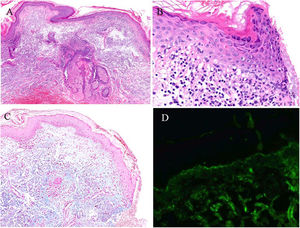 Estudio histológico de biopsia cutánea tomada de cuello. A) Imagen a gran aumento con presencia de infiltrado linfocitario parivascular y perianexial. B) Mayor detalle de la epidermis donde se observa degeneración vacuolar y presencia de algún queratinocito apoptótico. C) Tinción con azul alcián que demuestra depósito de mucina en la dermis. D) Estudio de inmunofluorescencia directa con depósito lineal granular de C3 en la membrana basal.