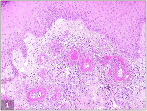 Livedoid vasculopathy, histopathological picture: Fibrin deposition within both the wall and lumen of dermal blood vessels resulting in thickened vessels walls and vascular occlusion by thrombosis. Dermal fibrosis and a perivascular lymphocytic infiltrate are also observed (H&E, ×100).