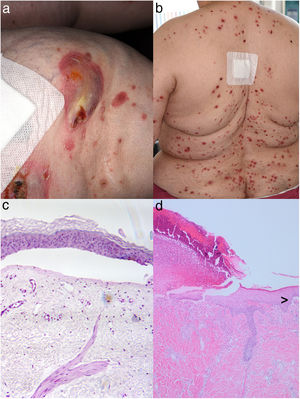 Showing crusty burst blisters on the right knee (a) and multiple papules with central dark plugs on the back (b) of a diabetic patient under DPP4i treatment. Histopathological examination of a skin biopsy specimen taken from the right knee revealed the presence of sub-epidermal bullae containing some perivascular lymphocytic infiltrates without eosinophils (c). Histology obtained from a papulous lesion on the upper back partly revealed transepidermal elimination of necrotic basophilic collagen bundles into a cup-shaped epidermal depression, whereas the here shown figure is dominated by ulceration (d; hematoxylin–eosin stain, magnification 200×). Interestingly, the border of a sub-epidermal blister formation is also seen (>; hematoxylin–eosin stain, magnification 100×).