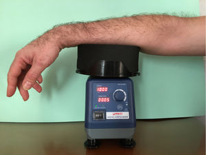 The volar surface of the forearm should be exposed to the vibration for 5minutes. This should be induced by a laboratory vortex mixer (780–1380rpm), with readings taken at 10minutes once the stimulus has stopped. The result is considered positive when inflammation resulting the vibratory stimulus induced by the movement of the vortex. According to recommendations from consensus guidelines (EAACI/GA(2)LEN/EDF/UNEV), inflammation can be quantified by measuring the circumference of the forearm at 3 points (cubital fossa, wrist, and midpoint between the two). This measurement should be made with a measuring tape before application of the vibratory stimulus and 5minutes afterwards.