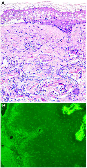 A, Histology indicating epidermal necrosis, normal stratum corneum, and mild perivascular and periadnexal lymphocytic infiltrate (hematoxylin-eosin, ×200). B, Indirect immunofluorescence. Immunofluorescence of the patient