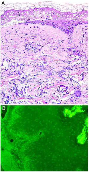 A, Histology indicating epidermal necrosis, normal stratum corneum, and mild perivascular and periadnexal lymphocytic infiltrate (hematoxylin-eosin, ×200). B, Indirect immunofluorescence. Immunofluorescence of the patient's blood in monkey esophagus revealed the presence of circulating immunoglobulin G antibodies bound to the nuclei of epithelial keratinocytes (dilution, 1:20; original magnification, ×200).