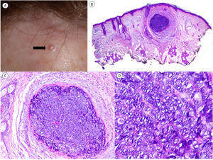Clinical and histopathologic findings. Clinical findings. A, Flesh-colored, 3-mm papule on the forehead. B, Hematoxylin–eosin staining (original magnification ×2). Panoramic view showing a small, well-defined nodule in the dermis. C, Hematoxylin–eosin, original magnification ×10). Higher-magnification view showing a well-delimited lesion, without palisading and surrounded by some stroma without artifactual retraction. D, Hematoxylin–eosin, original magnification ×20). Higher-magnification view showing basaloid cells with a vesicular nucleus. Note the mitoses in the field shown.