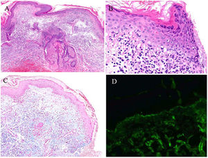 Histologic study of the skin biopsy taken from the neck. (A) High-magnification image showing perivascular and periadnexal lymphocytic infiltrate. (B) Greater detail of the epidermis showing vacuolar degeneration and some apoptotic keratinocytes. (C) Staining with alcian blue showing mucin deposits in the dermis. (D) Direct immunofluorescence study with granular linear deposit of C3 in the basement membrane.