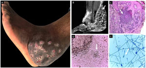 Eumicetoma: características clínicas (A), imagenológicas (B), histopatológicas (C) y culturales (D-E).