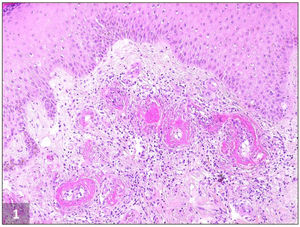 Imagen histopatológica de vasculopatía livedoide. Depósito de fibrina dentro de la pared y luz de los vasos sanguíneos dérmicos que origina engrosamiento de las paredes de los vasos y oclusión vascular debido a la trombosis. También se observan fibrosis dérmica e infiltrado linfocítico perivascular (H&E, ×100).