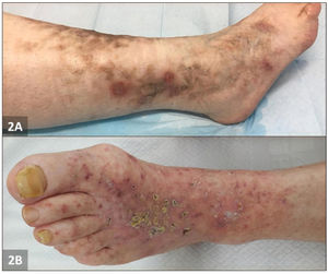 Imagen clínica de vasculopatía livedoide. A) Paciente 1: piel moteada y úlceras perforadas rodeadas de eritema purpúrico e hiperpigmentación. B) Paciente 2: múltiples ulceraciones y costras localizadas de tipo livedoide.