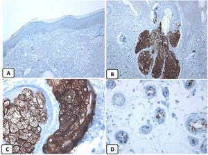 Expresión inmunohistoquímica de EMA en la piel normal. Tinción negativa de EMA en la epidermis (A, ×200), fuerte expresión de EMA en el citoplasma de las glándulas sebáceas maduras (B, ×200 y C, ×400). D) EMA positivo en la membrana luminal y los canalículos de la glándula sudorípara y la capa externa del conducto sudoríparo (D, ×200).