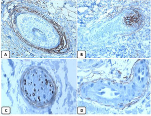 Expresión inmunohistoquímica de CD10 en la piel normal. CD10 citoplásmico positivo en células fusiformes mesenquimatosas perianexiales (A, ×400), papila pilosa de folículos vellosos (B, ×400). Algunos axones nerviosos (C, ×400) y células mioepiteliales de las glándulas sudoríparas (D, ×400).