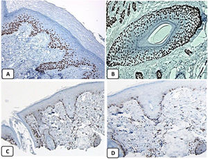 Expresión inmunohistoquímica de p63 y BCL-2 en la piel normal. Positividad nuclear de p63 en las células epidérmicas basales y algunas suprabasales (A, ×400) y en las células de la vaina radicular externa de los folículos pilosos (B, ×400). Expresión positiva de BCL-2 en los queratinocitos basales de la epidermis y en la vaina radicular externa queratinizada del istmo y en el infundíbulo del folículo piloso (C, ×200 y D, ×400).