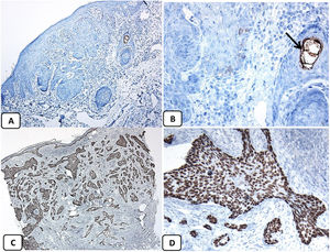 Expresión inmunohistoquímica de proteínas EMA y p63 en carcinoma basocelular. A y B) EMA negativa en el CBC excepto en las áreas con diferenciación escamosa (flecha) (A, ×200 y B, ×400). C y D) Positividad nuclear difusa e intensa de p63 en el CCB (C, ×100 y D, ×400).