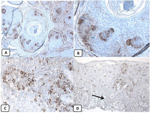 Expresión inmunohistoquímica de las proteínas CD10 y BCL-2 en el carcinoma de células basales. A y B) Tinción citoplasmática de CD10 en células de CBC, con una mayor positividad en las células periféricas (A, ×100 y B, ×400). C y D) Expresión citoplasmática positiva de BCL2 en el CBC, especialmente entre las células periféricas (C, ×400). Se observa una expresión reducida de BCL2 en las áreas infiltrativas (flecha) (D, ×200).