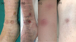 a) Úlceras profundas con un borde eritematoso y el fondo fibrinoso, a pesar de tratamiento con AINE, corticoides orales y curas locales. b) Tras dos ciclos de pembrolizumab, tanto la superficie como la profundidad de las úlceras ha mejorado. c) Nódulos subcutáneos eritematosos en los miembros inferiores con una distribución lineal. d) Resolución completa de los nódulos con una hiperpigmentación postinflamatoria leve, tras dos ciclos de pembrolizumab.