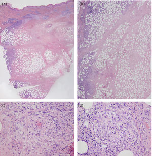 Imagen histológica (hematoxilina-eosina, x20) que muestra la afectación intensa de la dermis y del panículo adiposo a nivel septal y lobulillar a) con extensa necrosis en dichas localizaciones b), signos de vasculitis c) y escasos granulomas asociados d).