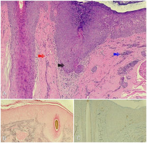 A) Histopatología: vacuolización de la capa basal, abundantes queratinocitos necróticos (flecha negra), fibrosis lamelar dérmica (flecha roja) e infiltrado inflamatorio mononuclear moderado (flecha azul). B) Tinción de Fontana Masson negativa para la presencia de melanocitos. C) Tinción inmunohistoquímica MelanA negativa para la presencia de melanocitos.