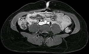 RMN. Lesión cutánea umbilical ovalada, con intensa captación de contraste, que contacta con la musculatura abdominal.