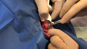 Exéresis de la lesión en la mucosa yugal.