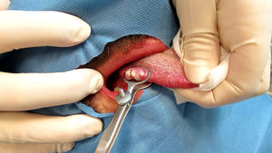 Biopsia de úlcera en la lengua.