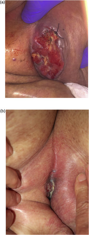 A) Masa ulcerada en ingle izquierda adherida a planos profundos de 8 x 9cm. B) Reducción significativa de la masa a las 8 semanas de tratamiento con bloqueo dual HER2.