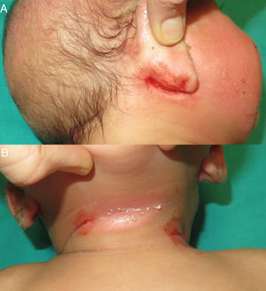 Placas de eccema sangrantes en la zona retroauricular (a) y el cuello (b).
