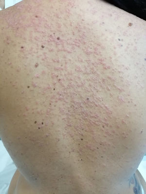 Imagen clínica. Lesiones papuloescamosas, eritematosas confluentes en la espalda.
