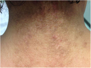 Lesiones tipo poiquilodermia, con zonas de piel atrófica en zona cervical posterior.