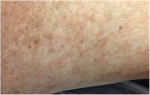 Lesiones tipo poiquilodermia con zonas de piel atrófica y cambios pigmentarios lentiginosos en brazos.