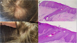 A: Alopecic inflammatory plaque on the vertex area. On top of it, white fine scales could be observed; C-D: Hematoxylin-eosin stain: Histopathological exam showing a psoriasiform pattern (c x4, d x100); B: Almost complete clinical recovery after two months of secukinumab cessation.