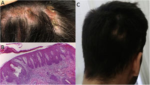 A: Alopecic inflammatory plaque with hyperkeratotic scales from where hair bundles emerged; B: Spongiotic dermatitis with involvement of the follicles, resembling a psoriasiform pattern, keratinocyte apoptosis and follicular hyperkeratosis; C: Hair recovery after cessation of secukinumab.