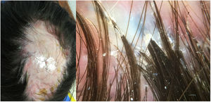 (a) Progresión de la placa de alopecia cicatricial, con presencia de costras amarillentas y signos inflamatorios en los márgenes de la placa. (b) Penachos foliculares en la tricoscopia.