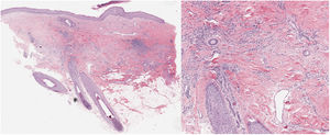 (a) Se objetiva un infiltrado inflamatorio perifolicular, sin lesión de la epidermis (HE ×4). (b) El infiltrado inflamatorio está formado principalmente por linfocitos, con escasas células plasmáticas y ausencia de lesión de interfase (HE ×10).