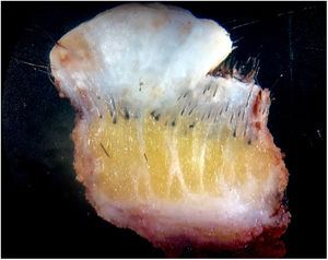 Multiples hair follicules and collagen bundles in the dermis and subcutaneous tissue of one hamartoma.