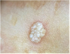Estructuras blancas brillantes visibles con dermatoscopia de luz polarizada.