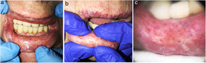 Clínica: A) Múltiples puntos eritematosos monomorfos, de distribución regular, submilimétricos en mucosa de labio inferior. B) Drenaje de material gelatinoso y transparente por los ostia con la presión suave. C) Dermatoscopia: estructuras redondeadas de aspecto cupuliforme, con centro más eritematoso, y un patrón vascular doble compuesto por vasos finos periféricos en horquilla y otros arrosariados agrupados en forma de huella digital.