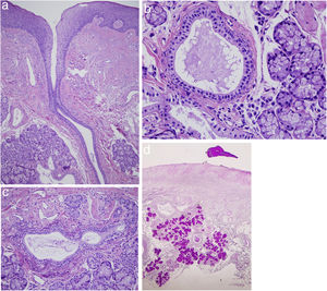 Histología (H&E, ×20): A) Glándulas salivares menores con dilatación ductal. B y C) Se objetivan imágenes de metaplasia escamosa y células plasmáticas en el intersticio glandular. D) En el interior de las luces se podía observar un material compacto, que se extendía hacia la superficie y era PAS positivo.