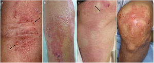 Vesiculo-bullous appearances (a: Case 4, b: Case 2, c: Case 5, d: Case 1).