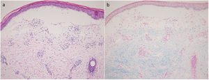 Histology showing subepidermal bulla (a; H–E stain). Mucin deposition below the bulla (b; colloidal iron stain).