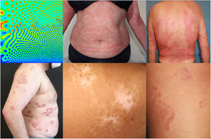 Simulación simplificada que representa varios de los patrones de Turing que se pueden obtener mediante los sistemas de reacción difusión. Comparativa con distintos patrones morfológicos presentes en dermatología.