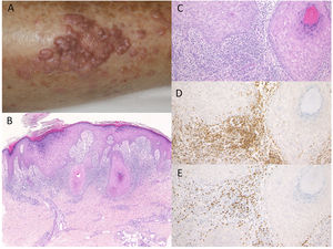 (A) Multiple, well-defined dark-red erythematous plaques with scales on the lower thighs. (B, C) Histological features showing focal hyperkeratosis with orthokeratosis, hyperplasia of the granular layer, irregular epidermal hyperproliferation, mild liquefaction degeneration of the basal layers, and edema of dermal papillae. HE, (B) ×100, (C) ×200. Infiltrating cells were immunoreactive for CD4, ×200 (D) and CD8, ×200 (E).