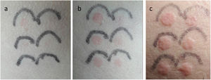Delayed response to SS exposure: (a) 6h, (b) 8h and (c) 10h after stimulation. Images show the appearance of wheals that disappeared after 24h. Irradiation doses with SS were (from upper left to lower left and then from lower left to upper right): 45.01, 33.31, 24.66, 18.25, 13, 51 and 10mJ/cm2.