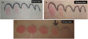 Delayed response to broad-band UVB light: (a) Erythema 8h later and (b) wheals 10h after stimulation, which disappeared 24h later. (c) MED determination. MED was 22mJ/cm2, considered to be normal for the patient phototype.